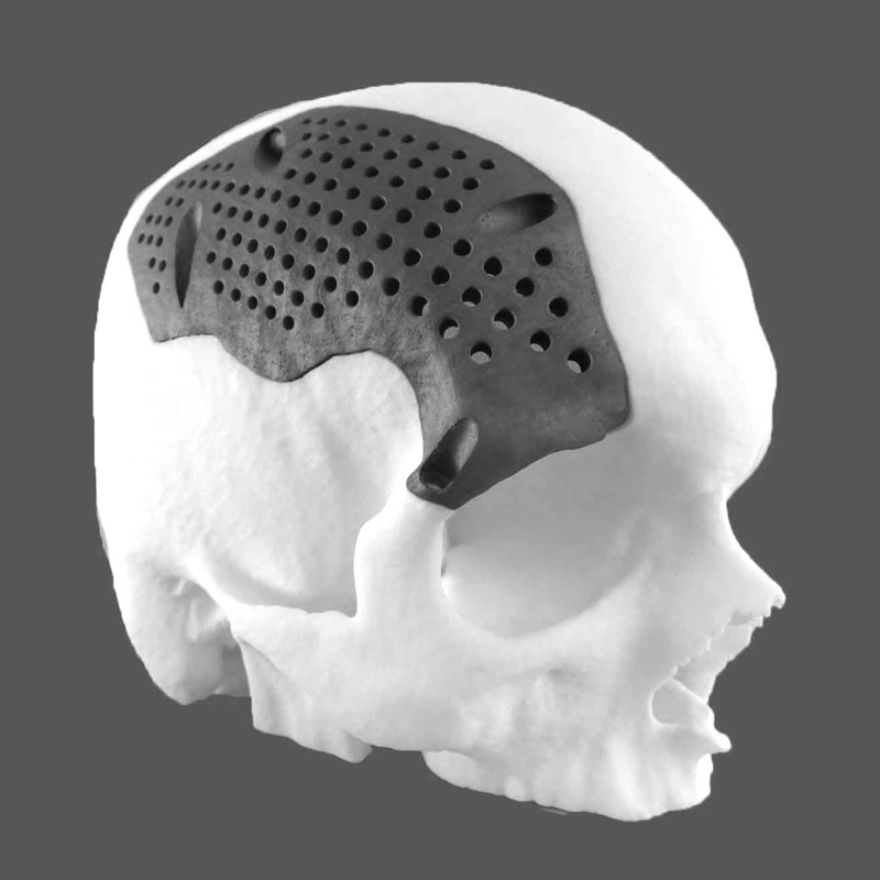 Healthcare medical cranial implant 3D printing